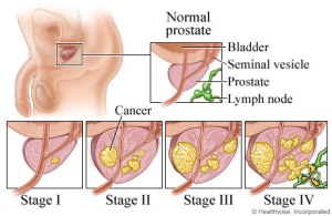 obat tradisional kanker prostat